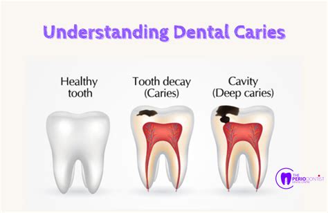 Understanding Dental Caries Causes Signs And Symptoms Prevention