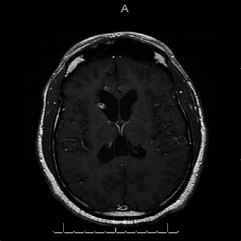 Brain Mri T1 Axial Image Post Gadolinium Showing Heterogeneous