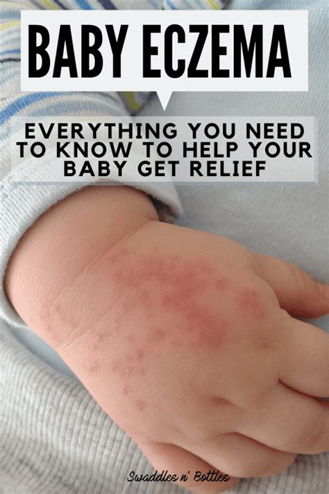 Baby Eczema Causes And Remedies Baby Eczema Remedies Baby Eczema