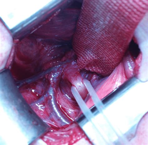 This occurs in up to 40% of patients with abscesses. The tracheoesophageal fistula is identified behind the ...