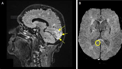 Two Month Acute Microangiopathic Brain Injury Follow Up In Severe Covid