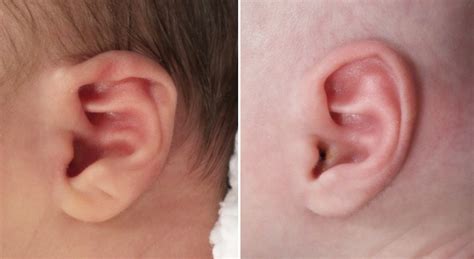 Should You Pierce A Babys Ears A Guide To Infant Ear 55 Off