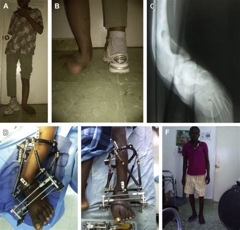Some of the more common conditions seen in children include Deformity Correction in Haiti with the Taylor Spatial ...
