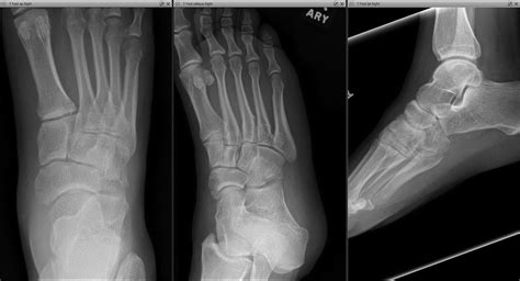 Surgical Management Navicular And Cuboid Fractures Clinics In