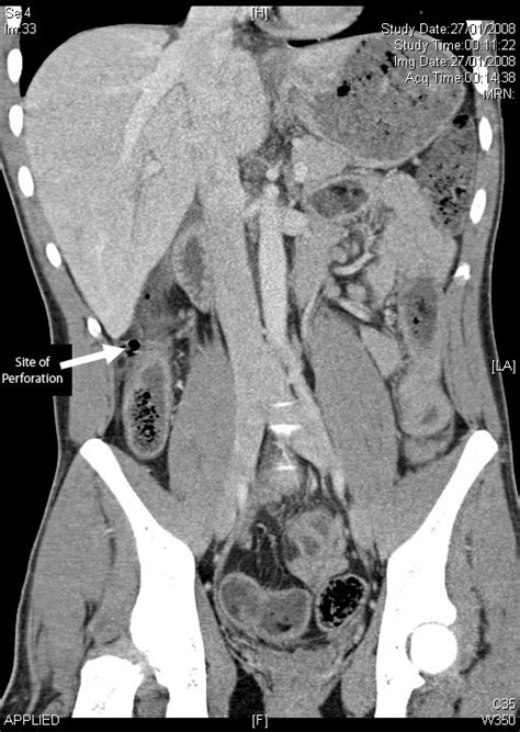 Colonic Perforation Following Mild Abdominal Trauma In A Patient With