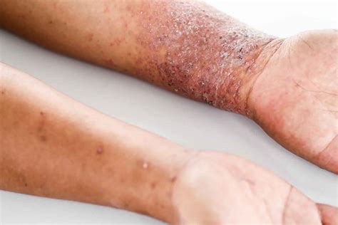 Dermatite No Rosto