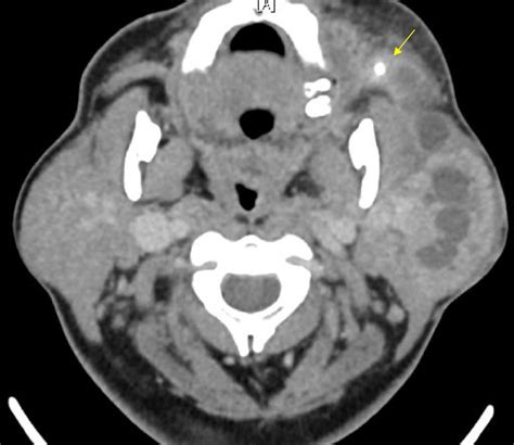 Parotitis And Sialendoscopy Of The Parotid Gland Otolaryngologic