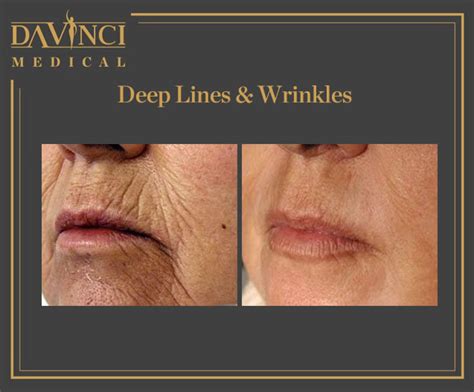 Da Vinci Clinic Deep Lines And Wrinkles Using Fotona Sp Dynamis Pro Laser