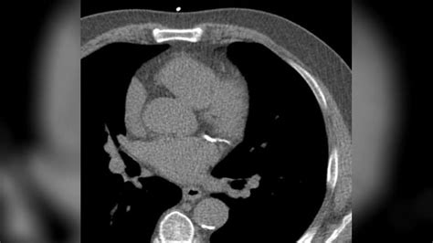 Cardiopatía Isquémica Papel De La Angiotomografía Computarizada Coronaria
