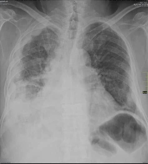 Symptom management is critical to quality of life. i have mesothelioma symptoms #Mesothelioma | Mesothelioma ...