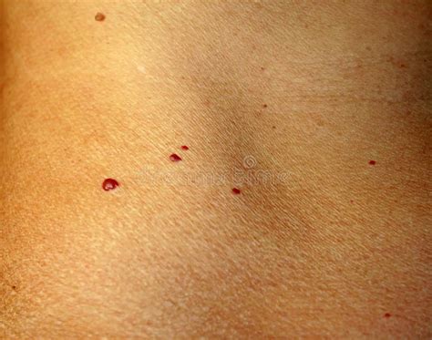 Angioma On The Skin Red Moles On The Body Many Birthmarks Stock