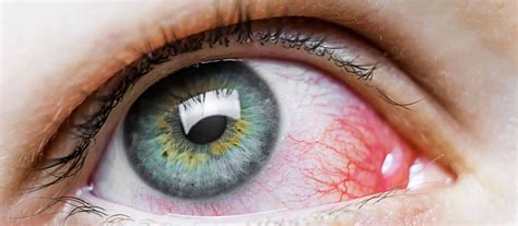 Causes Of Red Eye At Our Jenks Ok Optometry Clinic Insight Eyecare