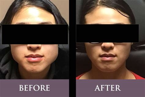 Botox Jawline Slimming In Harker Heights Tx At About Face
