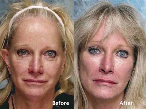 Lower Blepharoplasty Gone Wrong