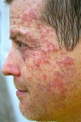 In some cases of rosacea, the skin might thicken and enlarge from excess tissue, resulting in a condition called rhinophyma. Skin Cancer Pictures Moles Symptoms Signs on Face Spots on ...