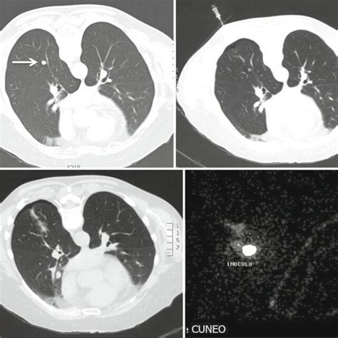 Chest Ct Showed An Enlarged Lobulated Nodule With A Maximum Diameter
