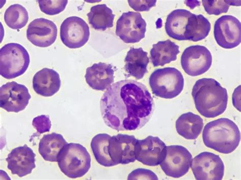 Canine Distemper Virus Cytoplasmic Inclusion Body (Blood s… | Flickr