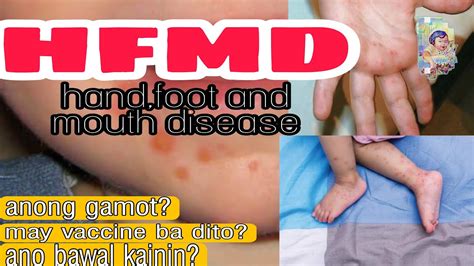 Rashes Sa Kamay Paa At Bibighand Foot And Mouth Disease Hfmd