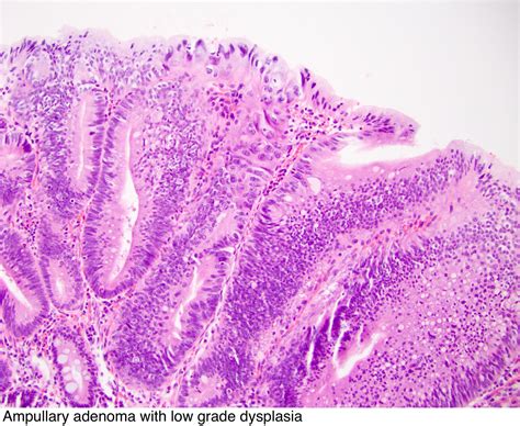 Lesions In The Ampulla Of Vater And Submucosal Lesions Of The Duodenum The Best Porn Website