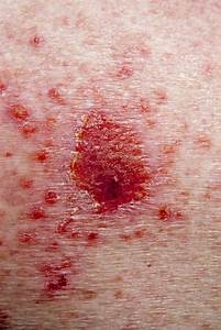 Skin Cancer: Early Stage Skin Cancer Skin Cancer  