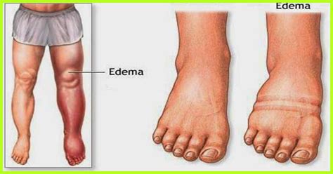 25 Remedies To Treat Edema Naturally Signs Causes And Types