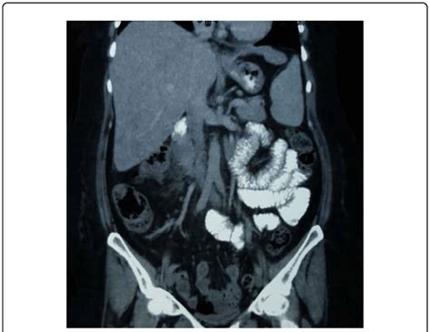 Computed Tomography Abdominal Scan With Oral And Intravenous Contrast