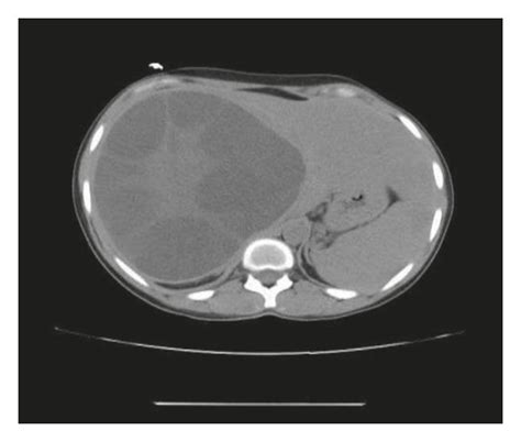 Noncontrast Ct Scan Showing A Giant Cyst Of The Liver Download