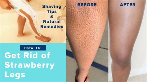 How To Get Rid Of Strawberry Legs Fast Like A Boss Easy Regimen At