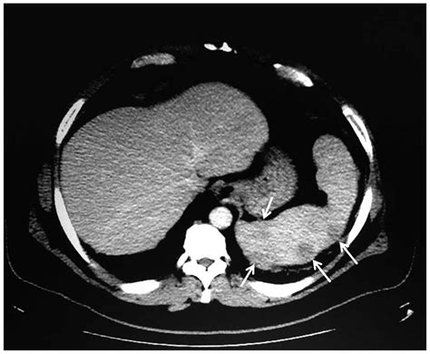Dht levels in men vs women. Alopecia areata as a paraneoplastic syndrome of Hodgkin's ...