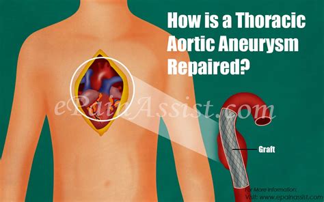 How Is A Thoracic Aortic Aneurysm Repaired