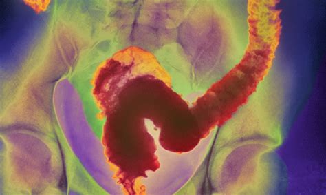 Irritable bowel syndrome, dyspepsia and other chronic disorders of