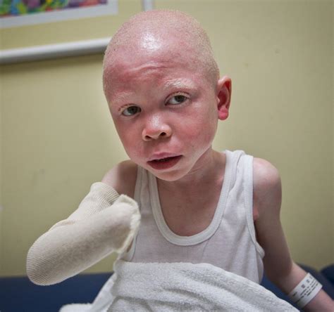 Albino Children Maimed In Tanzania Now Healing In Us