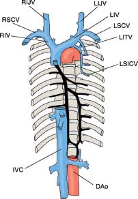 Abnormal Systemic Venous Connections | Thoracic Key