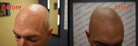 Male Baldness At What Age Do Men Go Bald Dermimatch Hair Clinic
