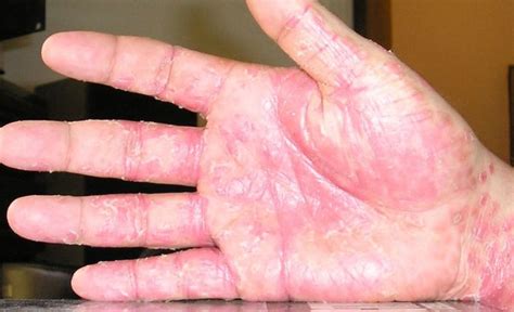 Peeling Skin On Hands Causes Prevention And Treatment Hubpages