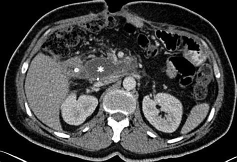 Axial Contrast Enhanced Computed Tomography Ct Image In A Patient