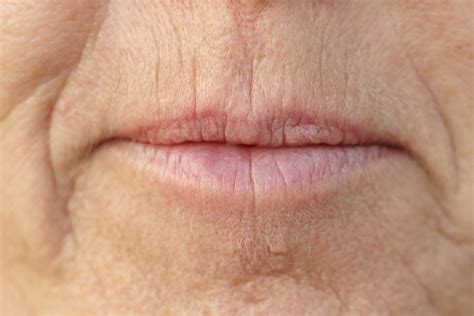 Smokers Lines How To Treat Upper Lip Lines And Wrinkles