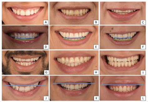 Classification Of Smile Line Smile Arc Smile Types And Upper Lip