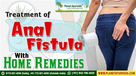 Treatment Of Anal Fistulaanal Fissure With Home Remedies Without Surgery Youtube