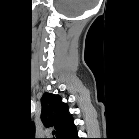 Filenormal Trauma Chest Pelvis And Spine Imaging Radiopaedia 31535