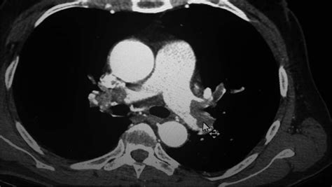 The Ct Angiography Of The Patient With Pulmonary Embolism Embolism Is