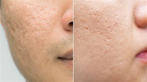Acne Scars 101 A Complete Guide To Getting Smooth Skin Again