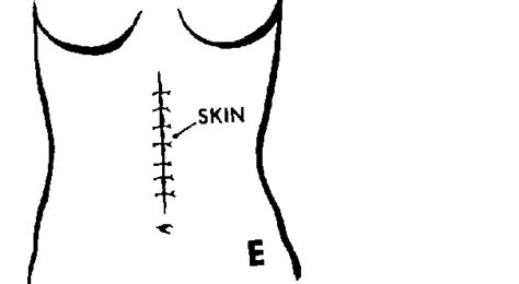 Closing An Abdomen Step 04 Routine Procedures For An Operation