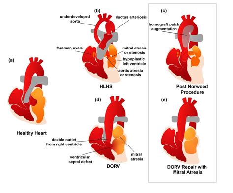 A Schematic Comparison Of The Physiology Of A Healthy Heart An Hlhs