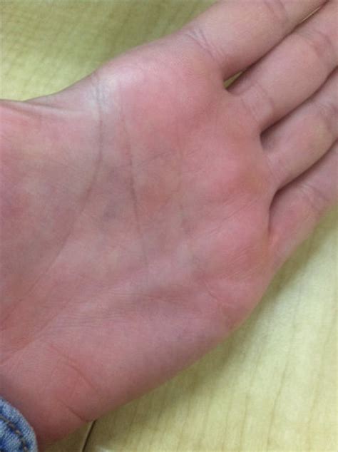 Help Lump In Palm Possible Pulley Injury Or Dupuytrens