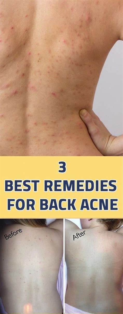 Back Acne This Is An Embarrassing And Embarrassing Skin Problem It