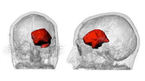 Steven Keating At Mit Studies His Own Brain Tumor Using Mri 3d Printing