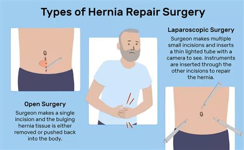 All About Hernia Surgery And Its Treatment Meril Life
