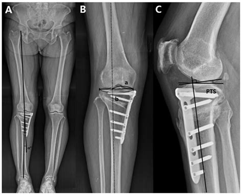 Should Sagittal Osteotomy Line Be Parallel To Tibial Posterior Slope In