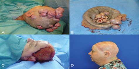 Surgical Treatment Of Brooke Spiegler Syndrome Journal Of